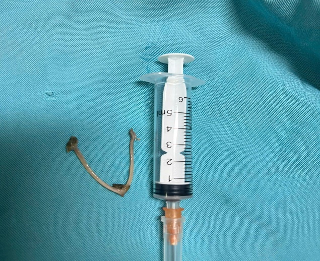 Gắp dị vật xương lớn tại thực quản – Ca bệnh khó được xử trí thành công tại Bệnh viện Đa khoa tỉnh Hải Dương